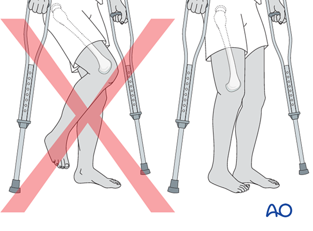 Non-weight bearing, holding the foot off the ground, can significantly increase the angular load on the healing fracture, worsen hip flexion contracture, and may lead to ankle equinus deformity.