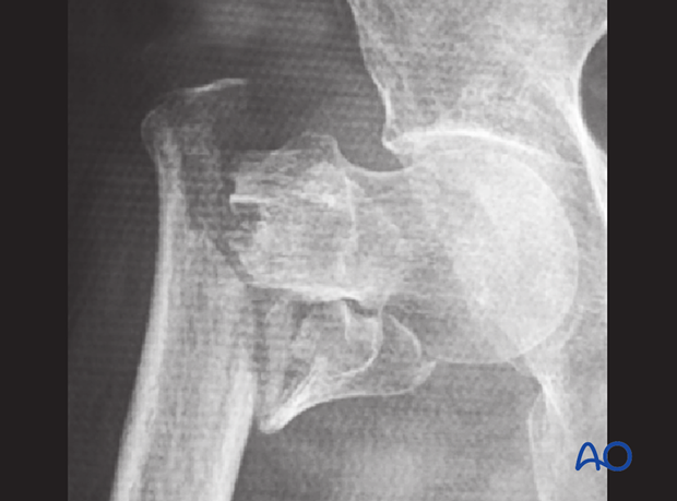 Plain x-ray of a trochanteric fracture displace with rotation and varus