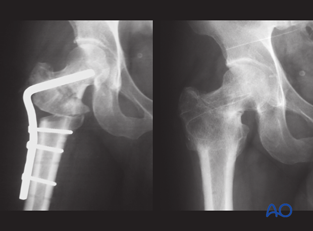 Nonunion of a basicervical femoral neck fracture treated with valgus trochanteric osteotomy