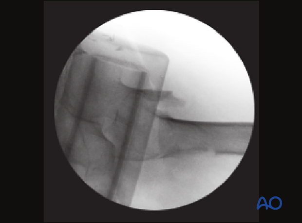 Axial view of a trochanteric fracture with a posterior translation of the shaft, sagging and slight anterior angulation of the proximal fragment