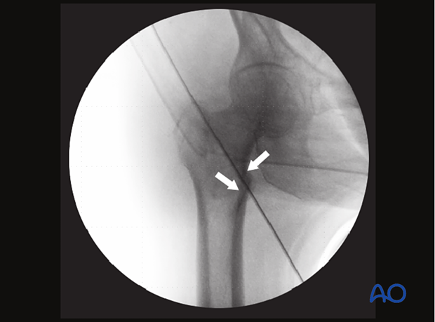 In this trochanteric fracture, the medial cortical line shows a step-off, which needs to be reduced because it tends to slide excessively (into the medullary canal).