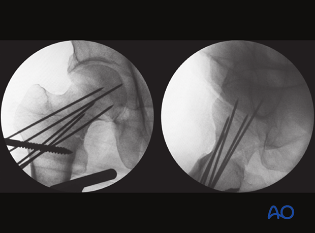 AP and lateral view of a femoral neck fracture with acceptable reduction temporarily stabilized with K-wires