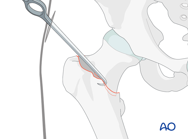 Hook leverage technique for a reduction of a step-off or neck-down deformity of a trochanteric fracture