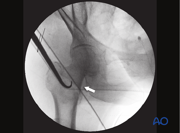 Hook leverage technique for a reduction of a step-off or neck-down deformity of a trochanteric fracture