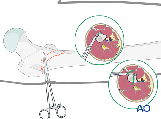 Kelly-clamp reduction of a low intertrochanteric fracture