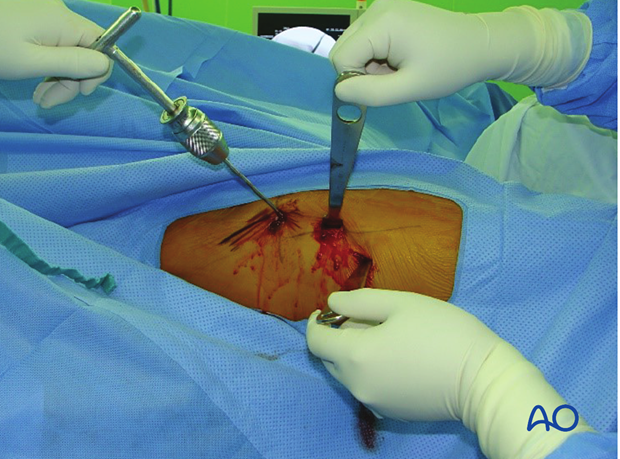 Attempt to reduce an intertrochanteric fracture with a trochanteric joystick and two Hohmann retractors