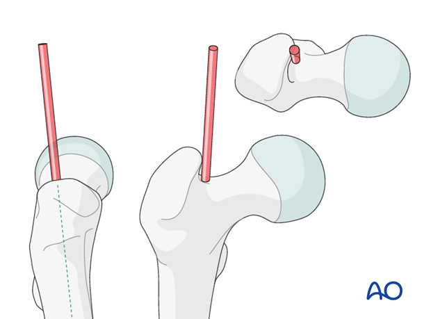 antegrade nailing approach with piriformis entry point