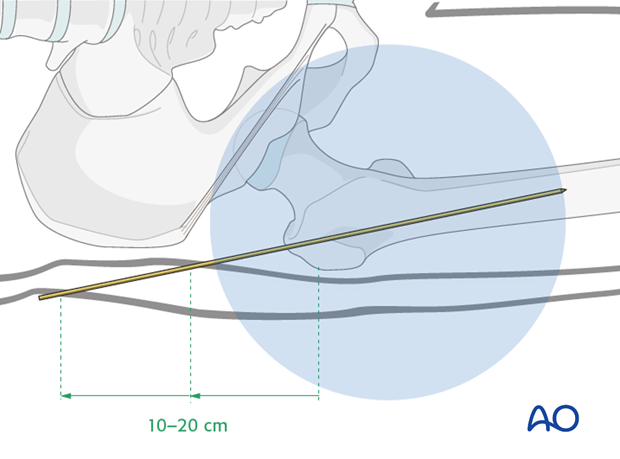 antegrade nailing approach with piriformis entry point