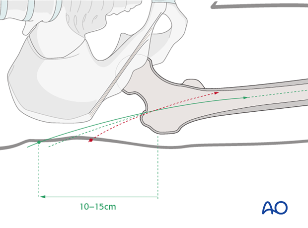 antegrade nailing approach with piriformis entry point