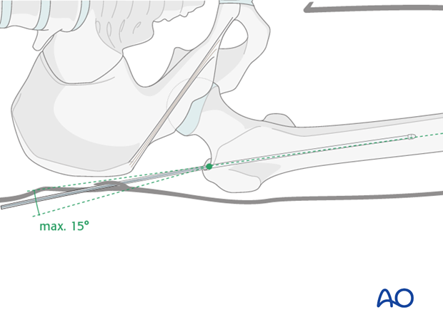 antegrade nailing approach with piriformis entry point