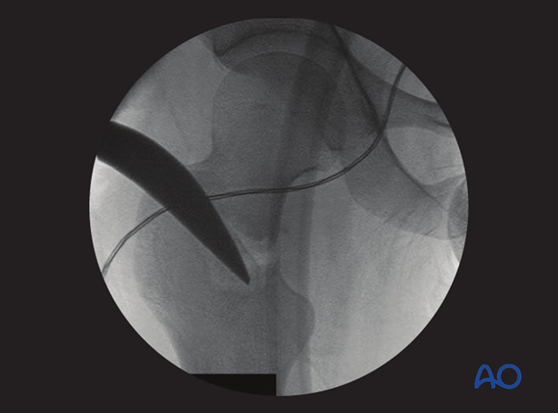 antegrade nailing approach with piriformis entry point