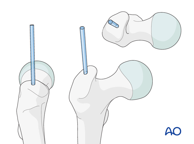 antegrade nailing approach with trochanteric entry point