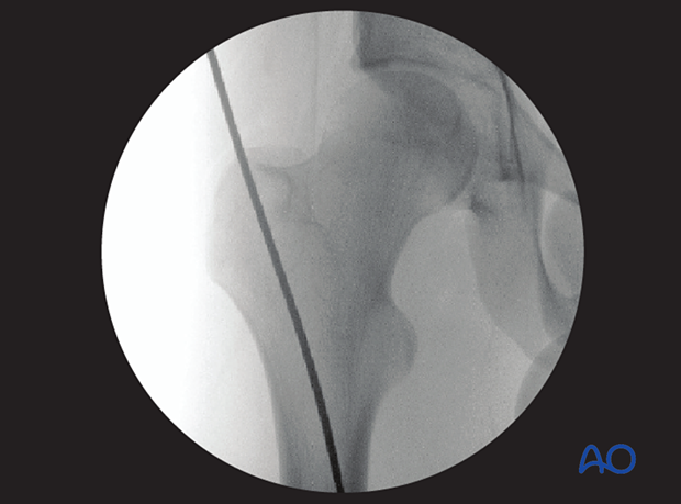 Antegrade nailing femoral shaft – trochanteric entry point – Guide wire