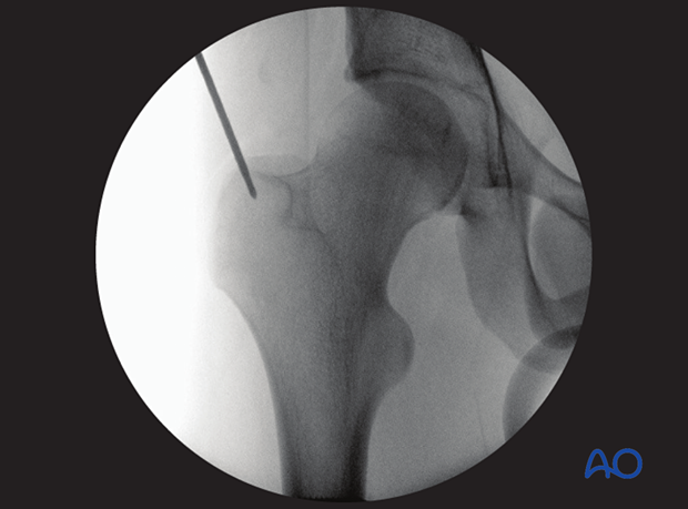 antegrade nailing approach with trochanteric entry point