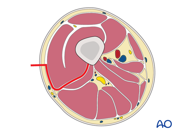 Lateral approach to femoral shaft - Principles