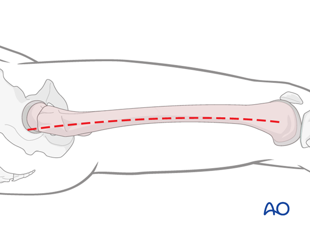 Lateral approach to femoral shaft – Skin incision