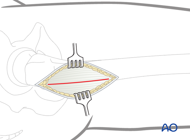 Minimally invasive osteosynthesis – Approach femur – Sub trochanteric - Exposure