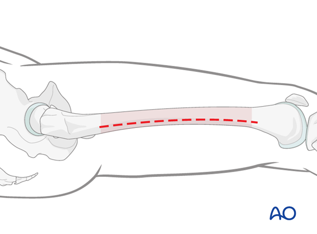 Minimally invasive osteosynthesis – Approach femur – Midshaft - Incision