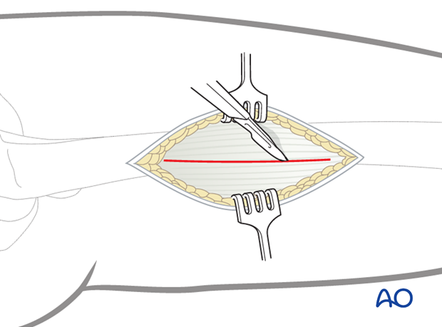 Minimally invasive osteosynthesis – Approach femur – Midshaft - Dissection