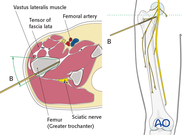 Safe zones femoral shaft – Proximal third