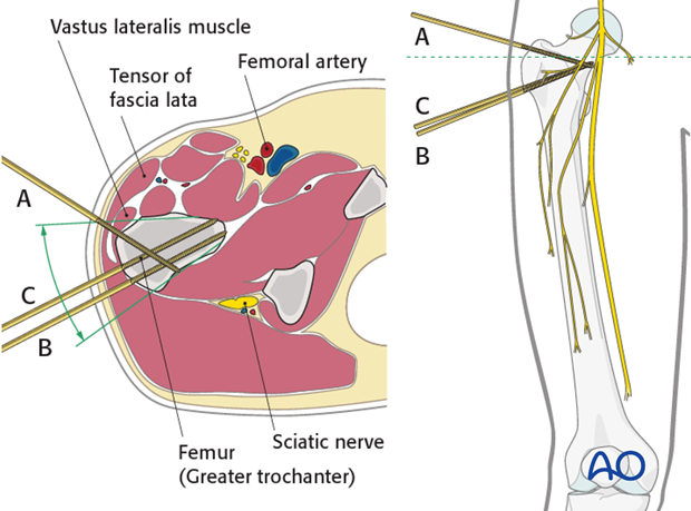 Safe zones femoral shaft – Proximal third