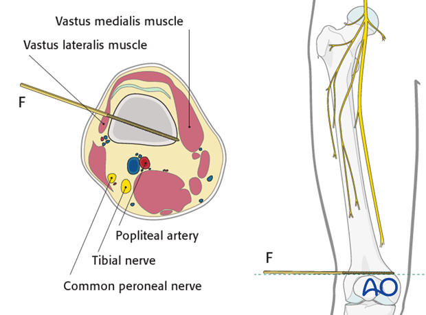 Safe zones femoral shaft – Distal third – Direct lateral