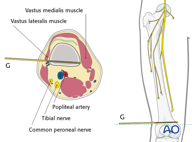 Safe zones femoral shaft – Distal third – Posterolateral