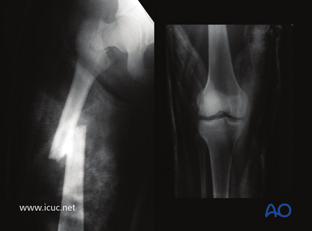 Preoperative images with ipsilateral femoral neck, femoral shaft, and distal femur condylar fracture in a 20-year-old patient