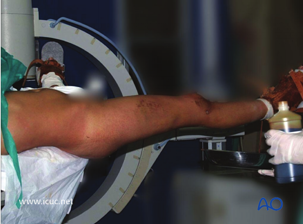 Intraoperative view of patient on fracture table