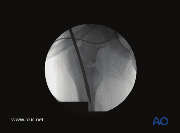 Insertion of initial T-handle reamer for nail placement