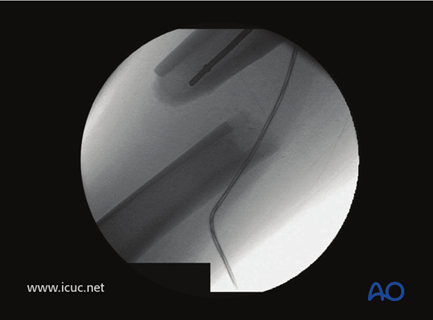 Ball-tip guide wire at fracture site before fracture reduction