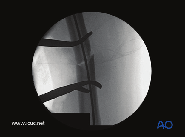 The incision was enlarged to allow a bone clamp to be placed on each of the main fragments.