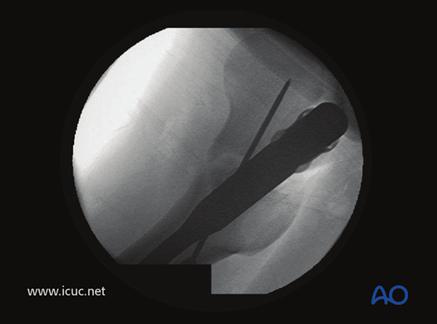 Lateral image showing guide wire with fractured femoral neck.