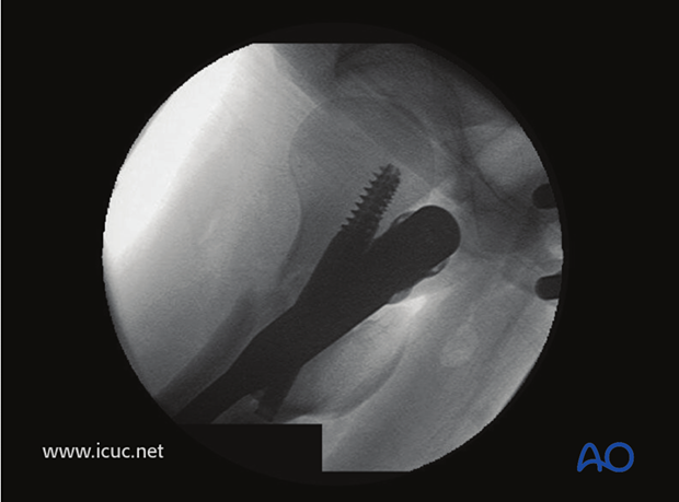 Lateral intraoperative image of final reduction showing slight malreduction of the femoral neck, but now with minimal distraction