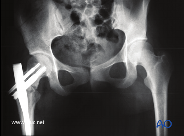 Postoperative AP pelvis image