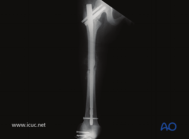 4 weeks postoperative X-ray showing good fracture alignment, but no callus