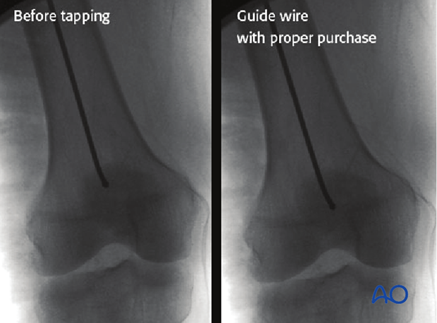 Antegrade nailing – Subtrochanteric femoral fracture – Correct guide wire insertion