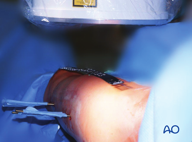 Femoral shaft – Antegrade nailing - Nail length and diameter using radiographic ruler