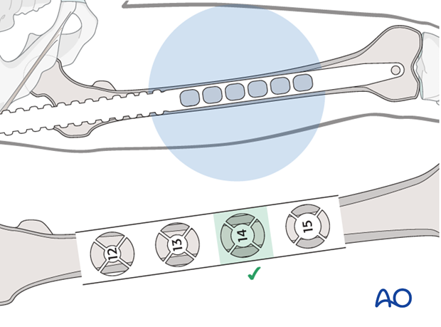 Femoral shaft – Antegrade nailing - Nail length and diameter using radiographic ruler