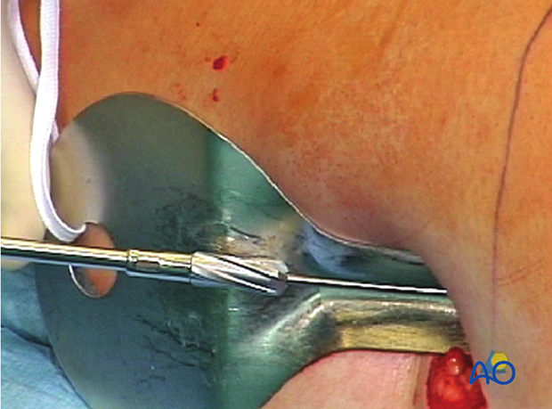 Femoral shaft – Antegrade nailing – Insertion of reaming rod