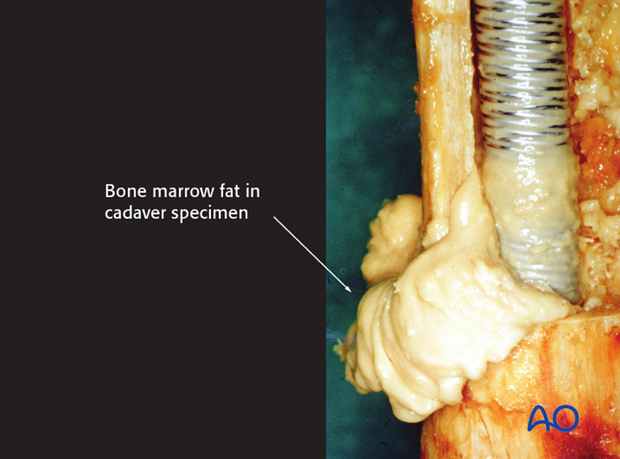 Femoral shaft – Antegrade nailing – fat embolization during reaming