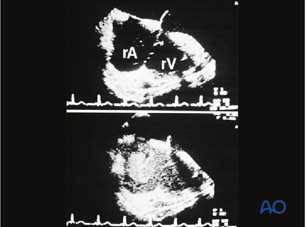 Femoral shaft – Antegrade nailing – Reaming