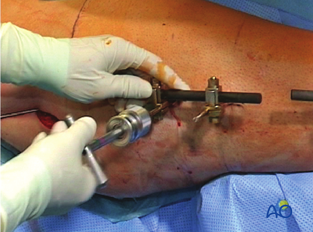 Femoral shaft – Antegrade nailing – conversion from external fixator to intermedullary nail