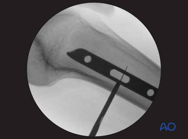 Femoral shaft – Antegrade nailing – Distal aiming