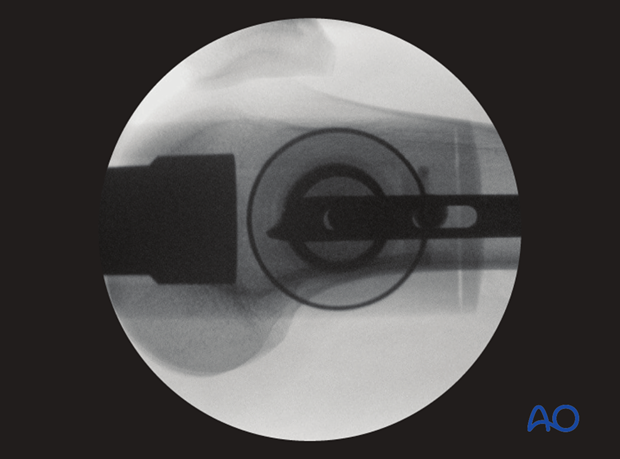 Femoral shaft – Antegrade nailing – Screw insertion for locking