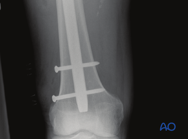 Femoral shaft – Antegrade nailing – Screw loosening