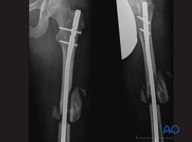 Antegrade nailing – Subtrochanteric femoral fracture – Proximal locking