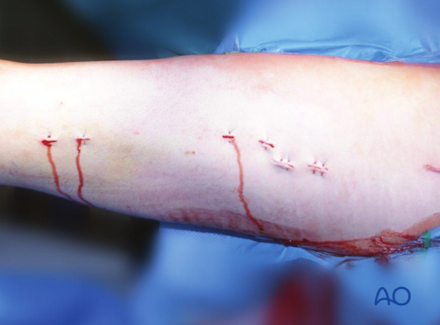 Femoral shaft – Antegrade nailing – Wound closure and assessment of alignment