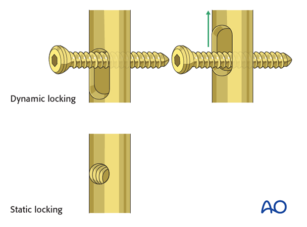 antegrade nailing