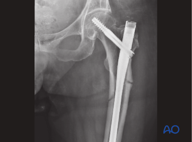 Antegrade nailing – Subtrochanteric femoral fracture – 